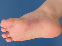 Acral peeling skin syndrome