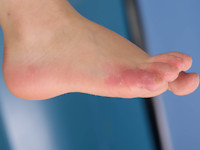 Acral peeling skin syndrome