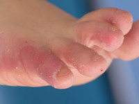 Acral peeling skin syndrome