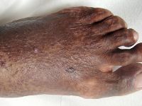 Acro-angiodermatitis