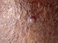 Acro-angiodermatitis