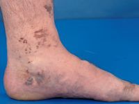 Acro-angiodermatitis