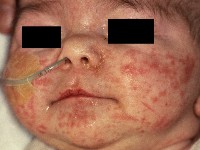 Acrodermatitis acidemica