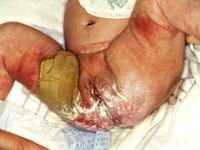 Acrodermatitis acidemica