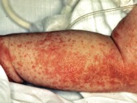 Acrodermatitis acidemica