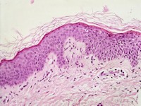Acrodermatitis acidemica