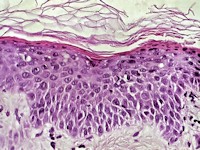 Acrodermatitis acidemica
