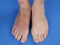 Acrodermatitis chronica atrophicans