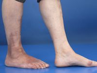 Acrodermatitis chronica atrophicans