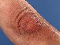 Acrodermatitis chronica atrophicans