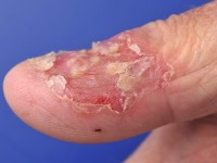 Acrodermatitis continua van Hallopeau
