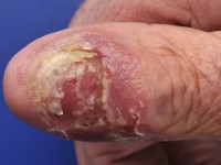 Acrodermatitis continua van Hallopeau
