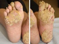 Acrodermatitis continua van Hallopeau