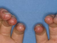 Acrodermatitis continua van Hallopeau