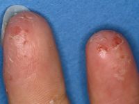 Acrodermatitis continua van Hallopeau