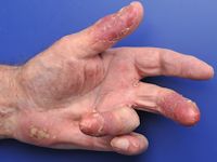Acrodermatitis continua van Hallopeau