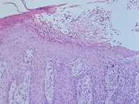 Acrodermatitis continua van Hallopeau
