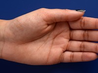 Acrokeratoelastoidosis