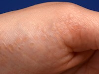 Acrokeratoelastoidosis