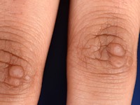 Acrokeratoelastoidosis