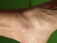 Acrokeratosis verruciformis van Hopf
