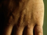 Acrokeratosis verruciformis van Hopf