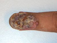 Acrolentigineus melanoom