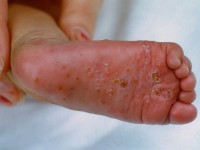 Acropustulosis infantum