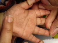 Acropustulosis infantum