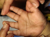 Acropustulosis infantum