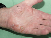 Acrovesiculeus eczeem