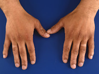 Acrovesiculeus eczeem