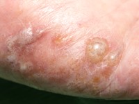 Acrovesiculeus eczeem