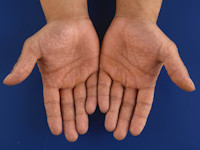 Acrovesiculeus eczeem