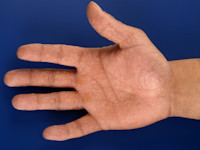 Acrovesiculeus eczeem