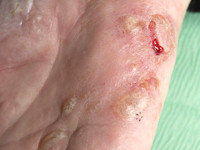 Acrovesiculeus eczeem