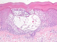 Spongiose bij acrovesiculeus eczeem