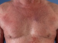 Actinisch reticuloid (chronische actinische dermatitis)