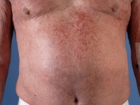 Actinisch reticuloid (chronische actinische dermatitis)