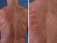 Actinisch reticuloid (chronische actinische dermatitis)