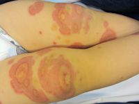 AHOI syndroom, acute hemorrhagic edema of infancy