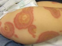 AHOI syndroom, acute hemorrhagic edema of infancy