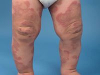 AHOI syndroom, acute hemorrhagic edema of infancy