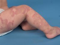 AHOI syndroom, acute hemorrhagic edema of infancy