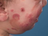 AHOI syndroom, acute hemorrhagic edema of infancy