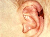 AHOI syndroom, acute hemorrhagic edema of infancy