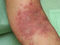 AGEP, acute gegeneraliseerde exanthemateuze pustulosis