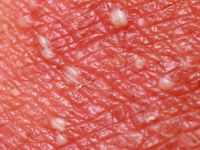 AGEP, acute gegeneraliseerde exanthemateuze pustulosis