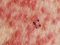 AGEP, acute gegeneraliseerde exanthemateuze pustulosis