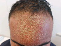 ALEP, acute localized exanthematous pustulosis